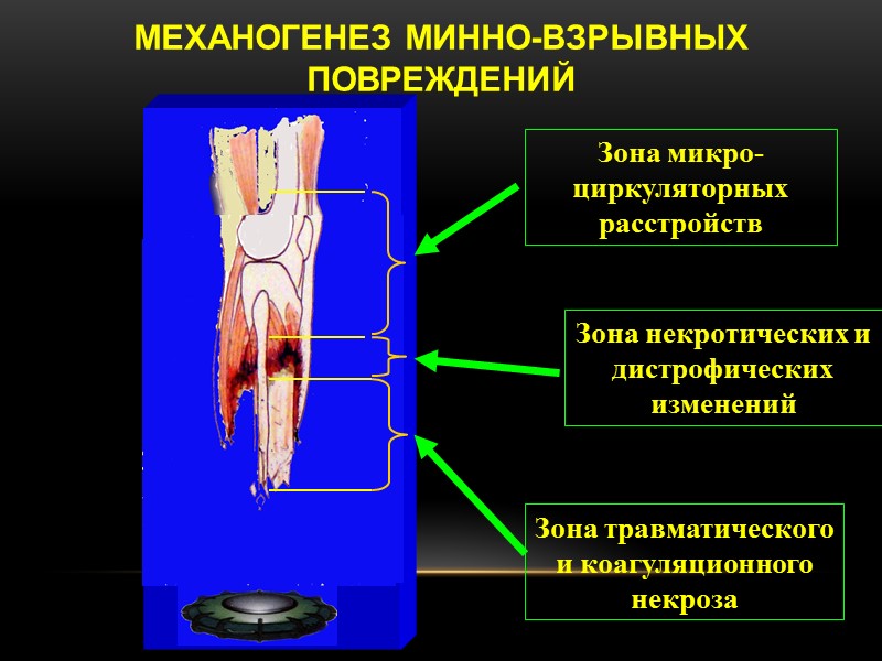 МЕХАНОГЕНЕЗ МИННО-ВЗРЫВНЫХ ПОВРЕЖДЕНИЙ